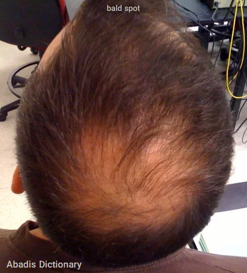 bald spot